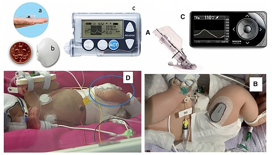 Commercially available subcutaneous CGM devices: (A) Dexcom G6