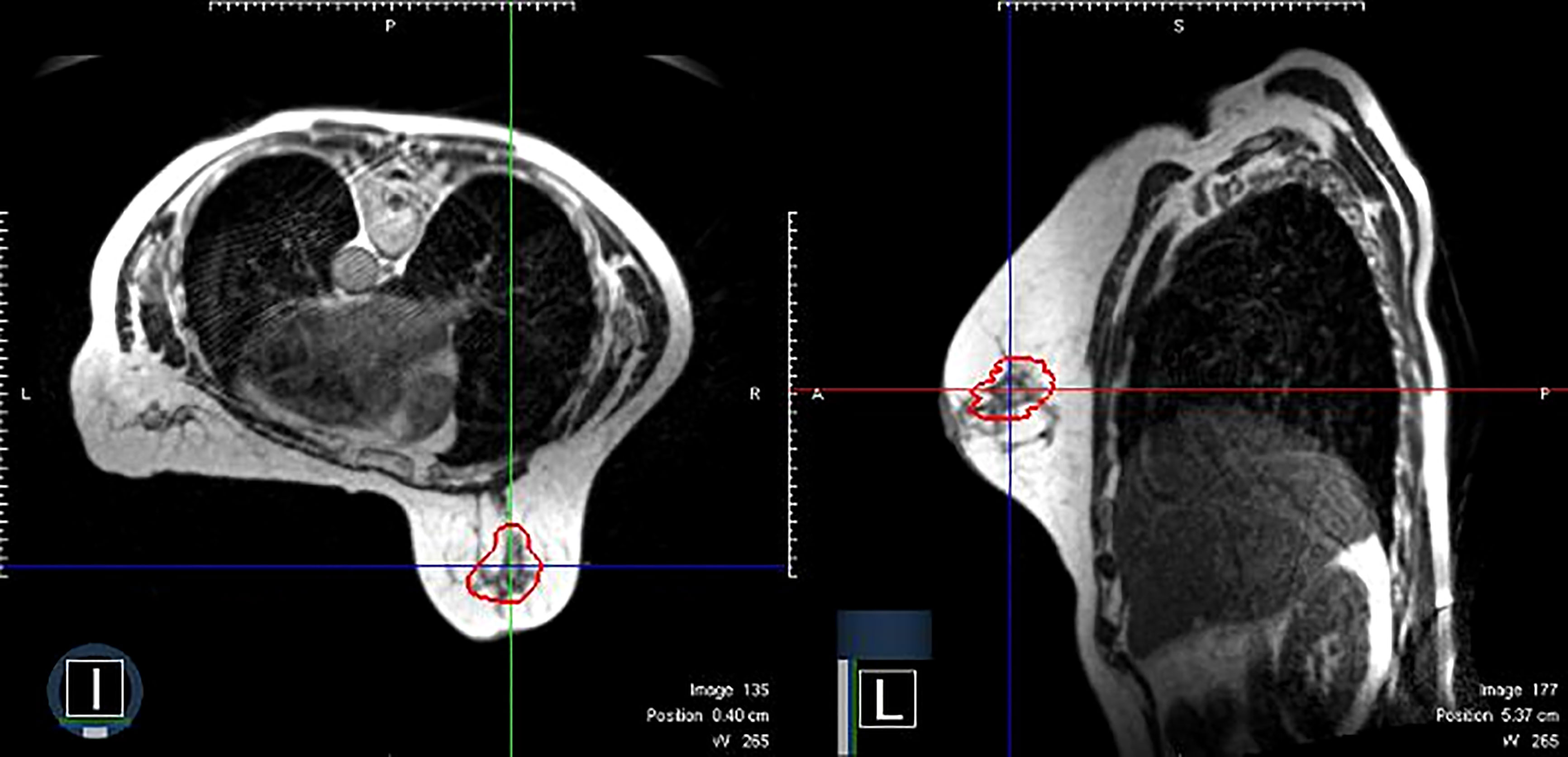 Control abdominal X-ray after passage of three stools without packets