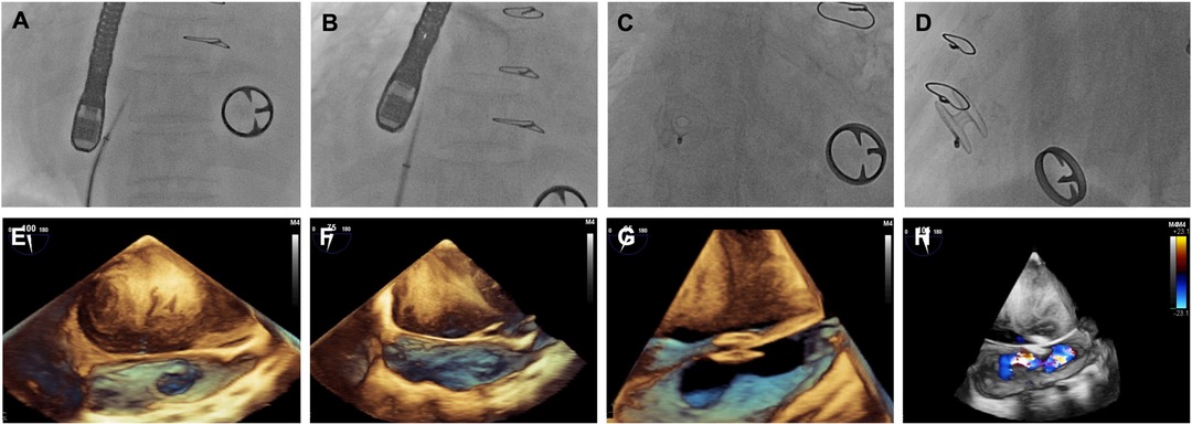 Global Longitudinal Strain: Is It Time to Change the Preoperative