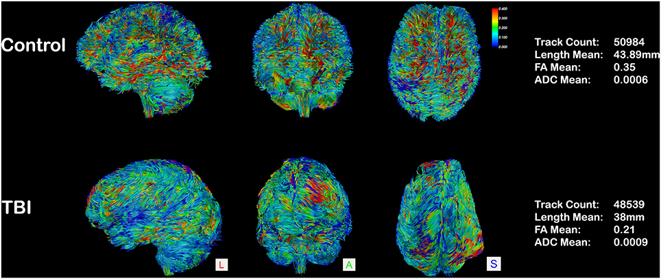 Diffusion Tensor Imaging in Traumatic Brain Injury, Neuropsychology