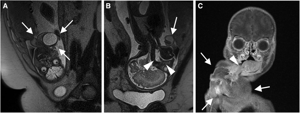 Frontiers | Case report and review of the literature: rare fetus-in ...