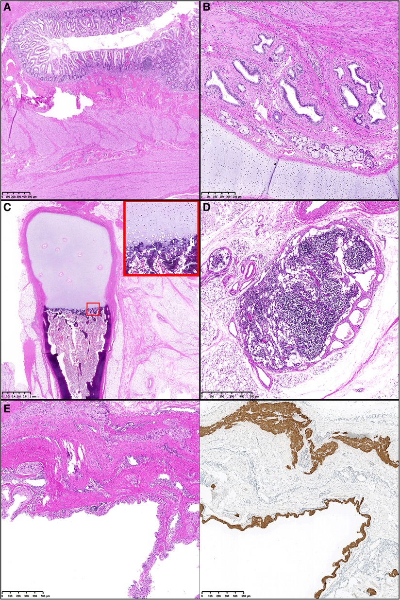 Frontiers | Case report and review of the literature: rare fetus-in ...