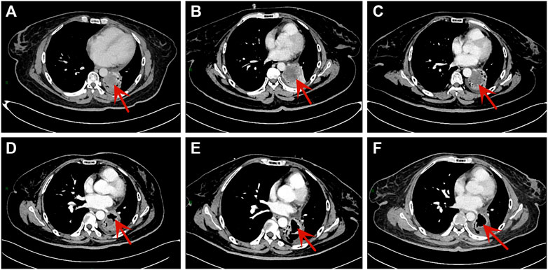 Error generating Gemini content - Frontiers | Posterior reversible encephalopathy syndrome after