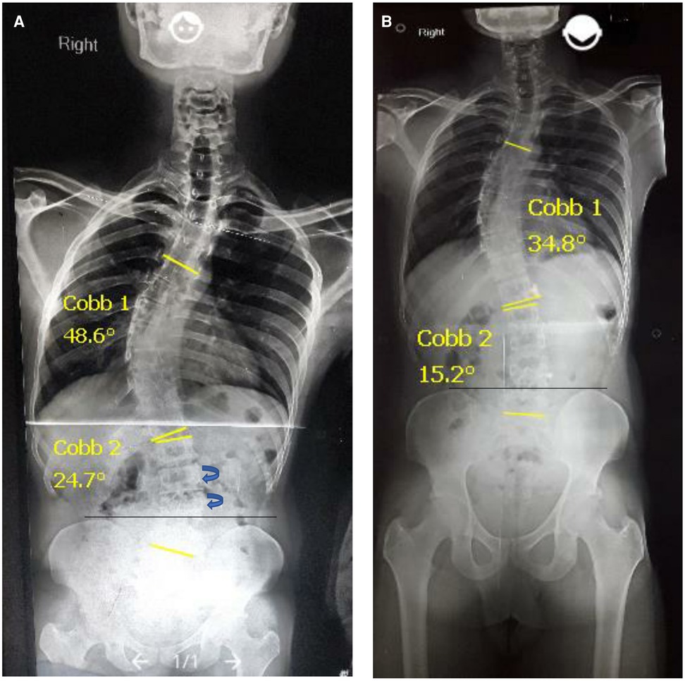 Lateral curvature of the spine and round shoulders . will sometimesshow a  slight tendency to curve to the right in the dorsal region, which  FUNCTIONAL SCOLIOSIS. SI may be due to