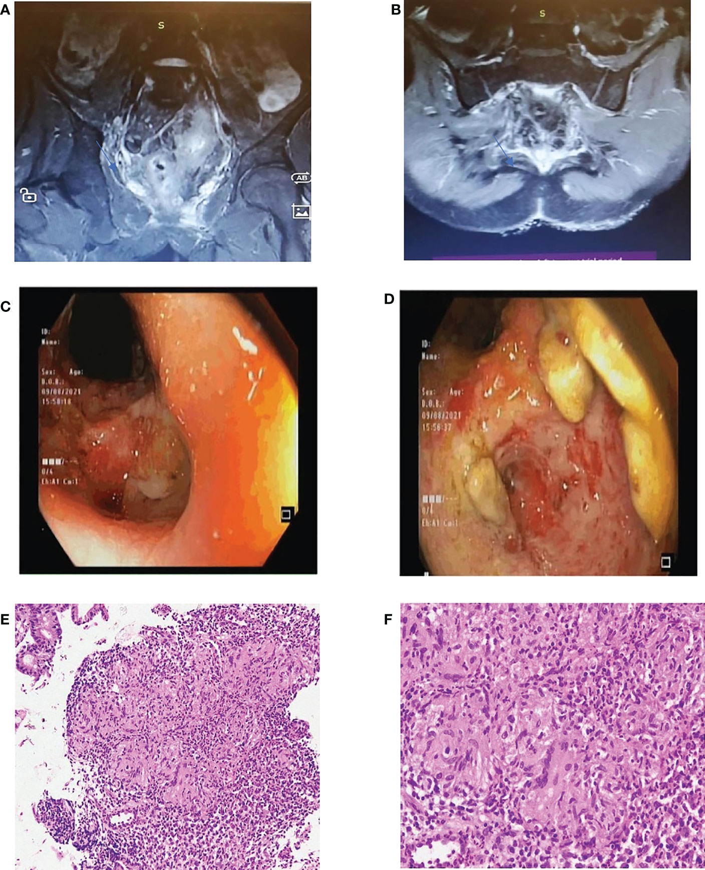 Frontiers Case Report Anal Tuberculosis Presenting As An Anal Fistula