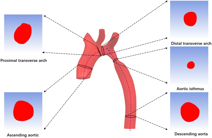 transverse arch aorta