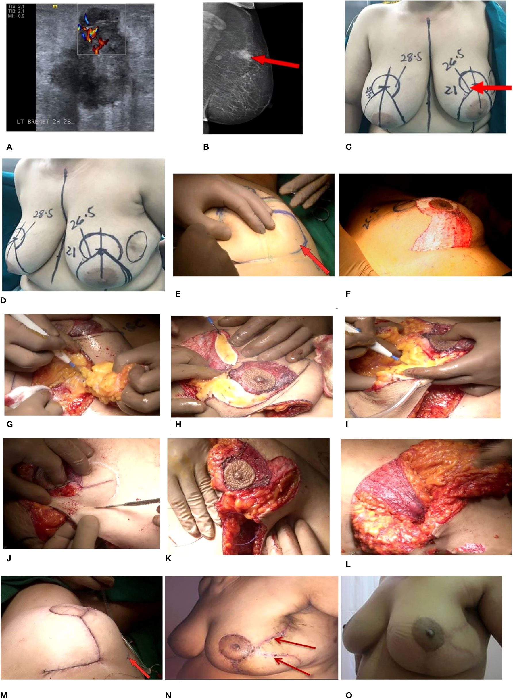 Breast Prostheses Choosing the right one! - Dr. Pragnya Chigurupati