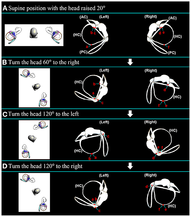 Frontiers  Correlation Between Benign Paroxysmal Positional