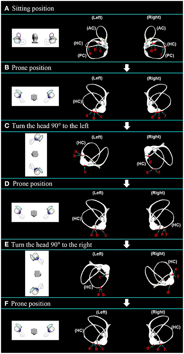 Frontiers  Correlation Between Benign Paroxysmal Positional