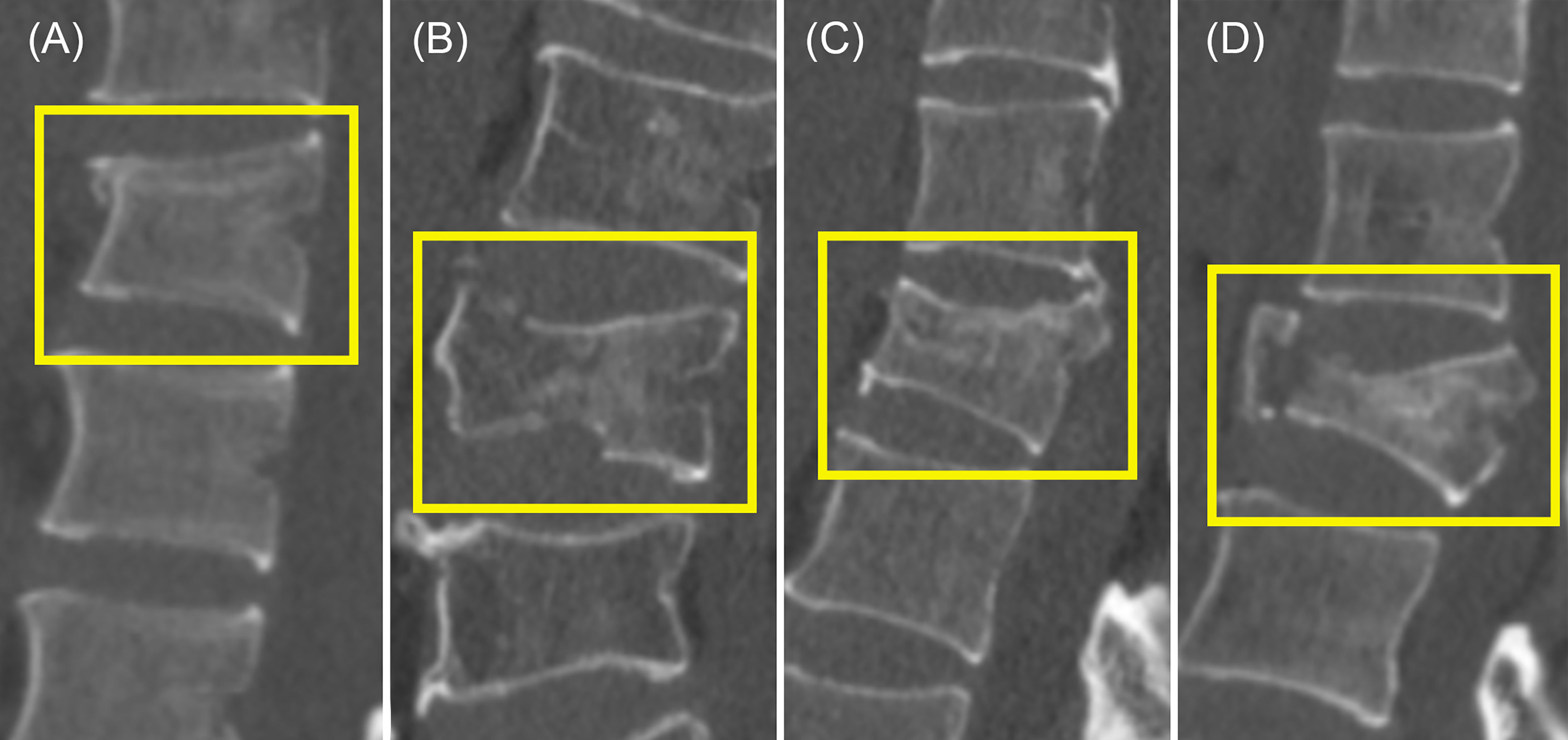 Decomposition Of Musculoskeletal Structures From 56 OFF
