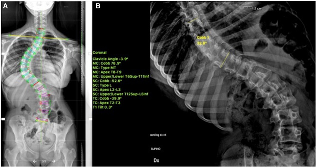 Predicting brace adherence could change the game in scoliosis treatment