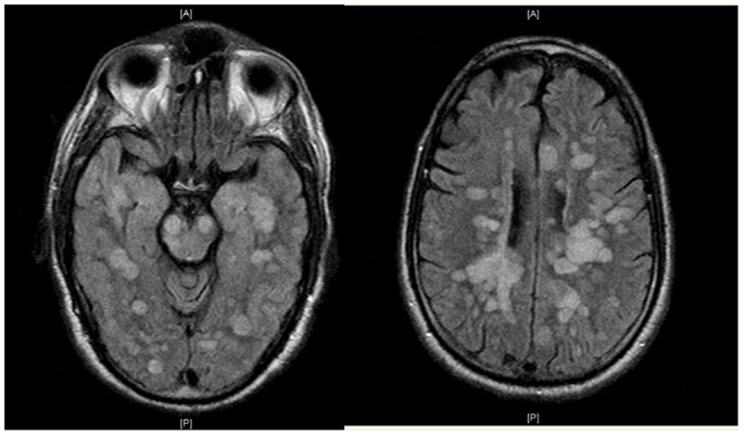 Frontiers | Refractory Fulminant Acute Disseminated ...