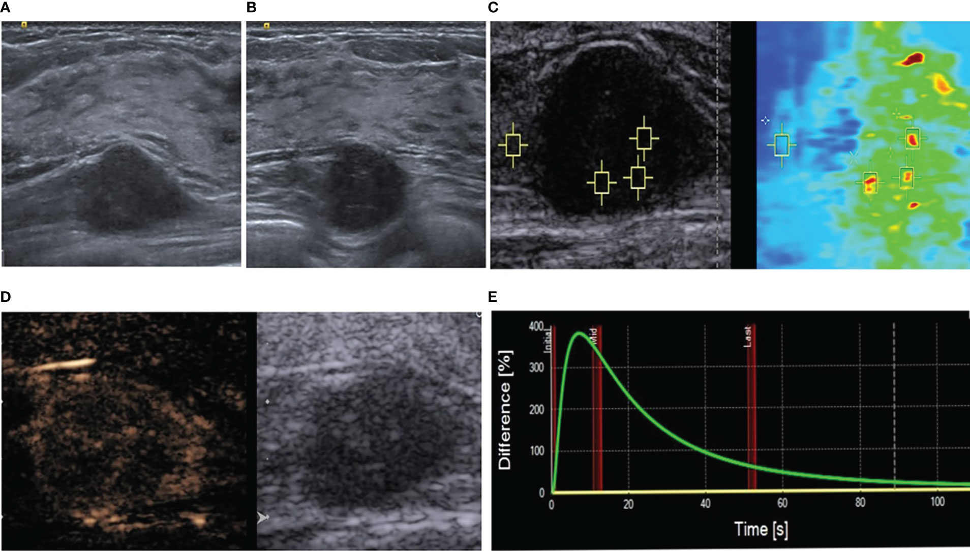 frontiers-multimodal-ultrasonography-findings-of-extramammary