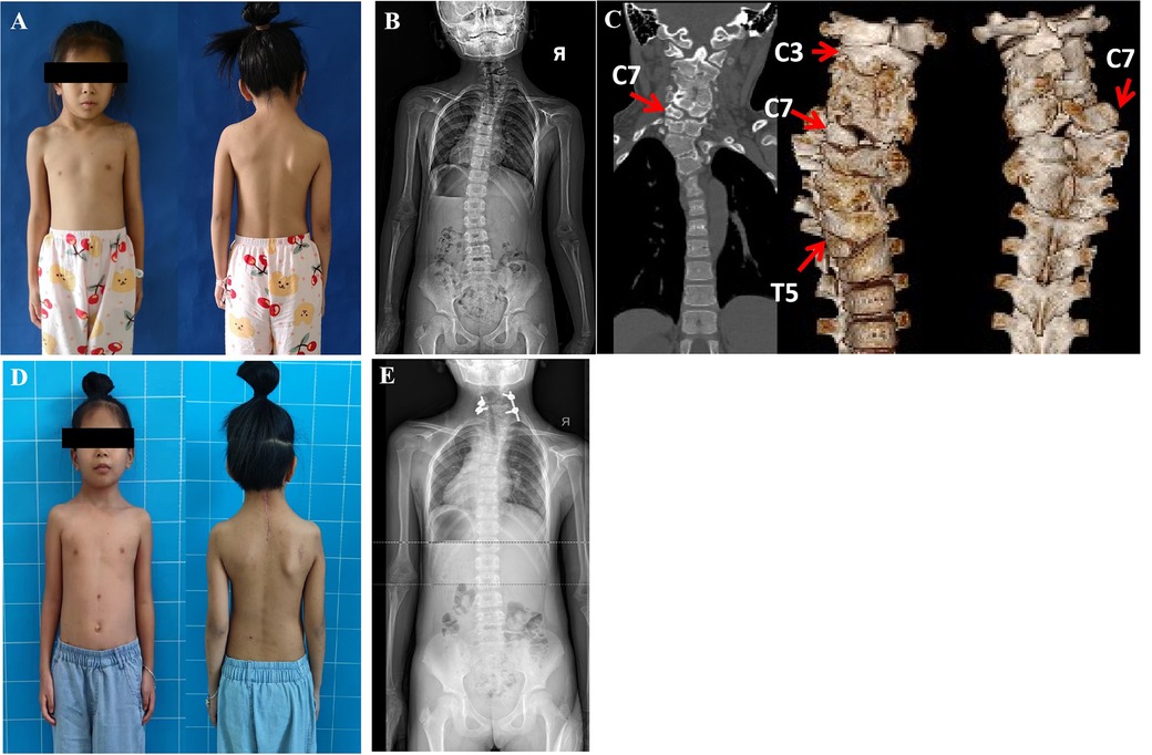 PDF) A review of minimally invasive techniques for correction of adult  spine deformity