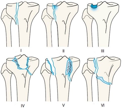 proximal tibia fracture icd 10