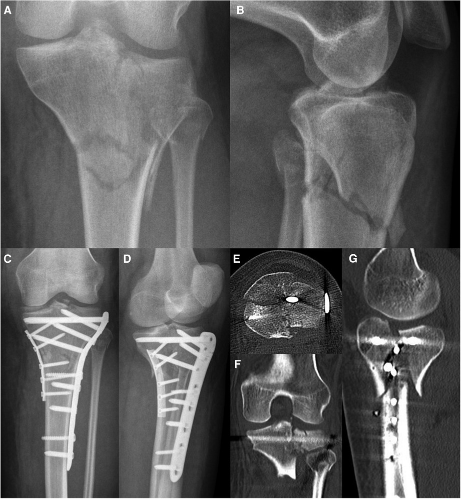 Full ring external fixation (Ilizarov) for Extraarticular, wedge fracture