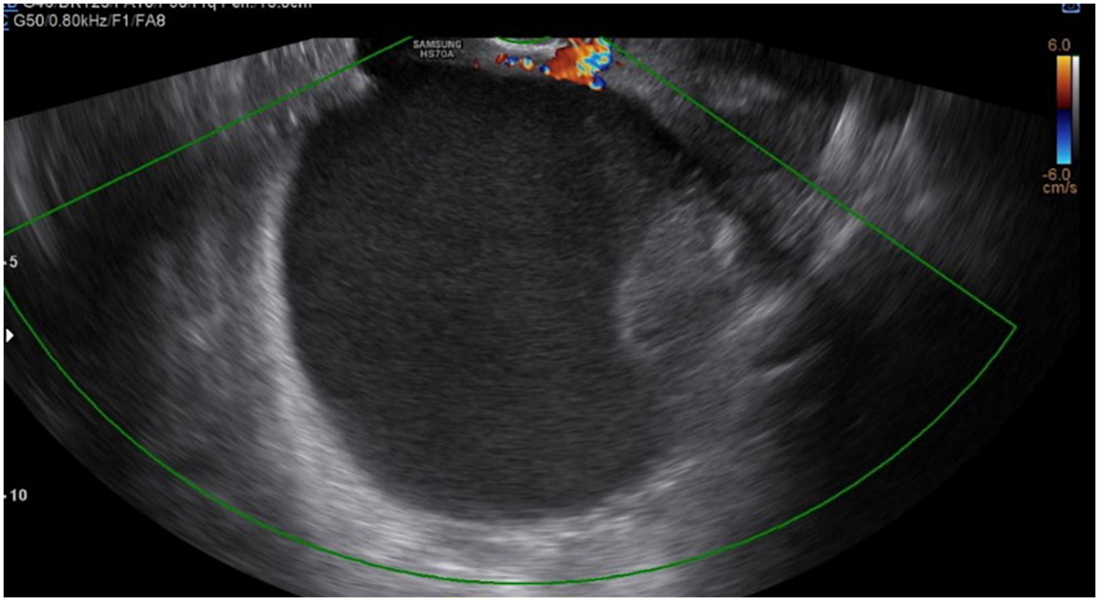 Frontiers Primary intestinal type mucinous adenocarcinoma of the ovary diagnosed during pregnancy photo photo