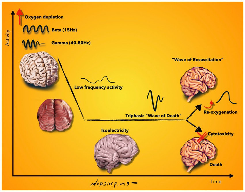 Harvard Panel Asks Definition of Death Be Based on Brain; DEATH