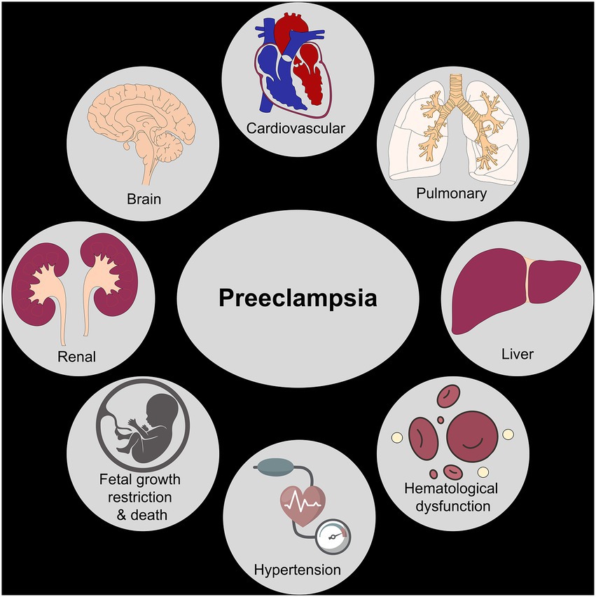 Preeclampsia Pictures