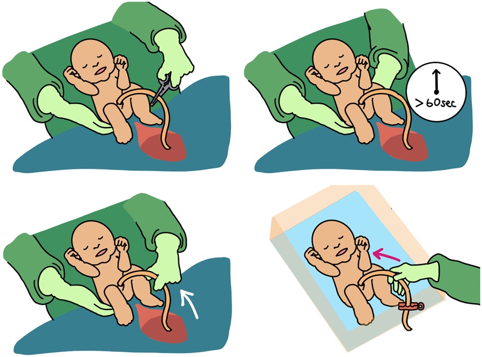 Frontiers  Umbilical cord milking-benefits and risks