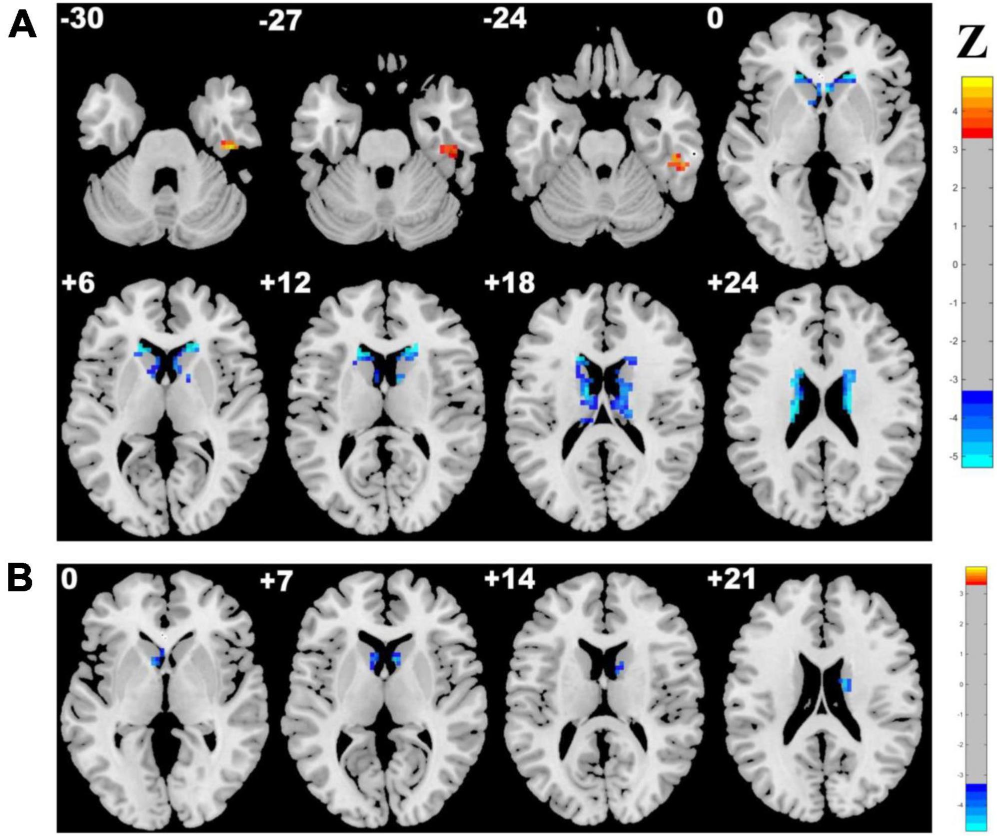 Frontiers  Abnormal whole-brain voxelwise structure-function coupling and  its association with cognitive dysfunction in patients with different  cerebral small vessel disease burdens