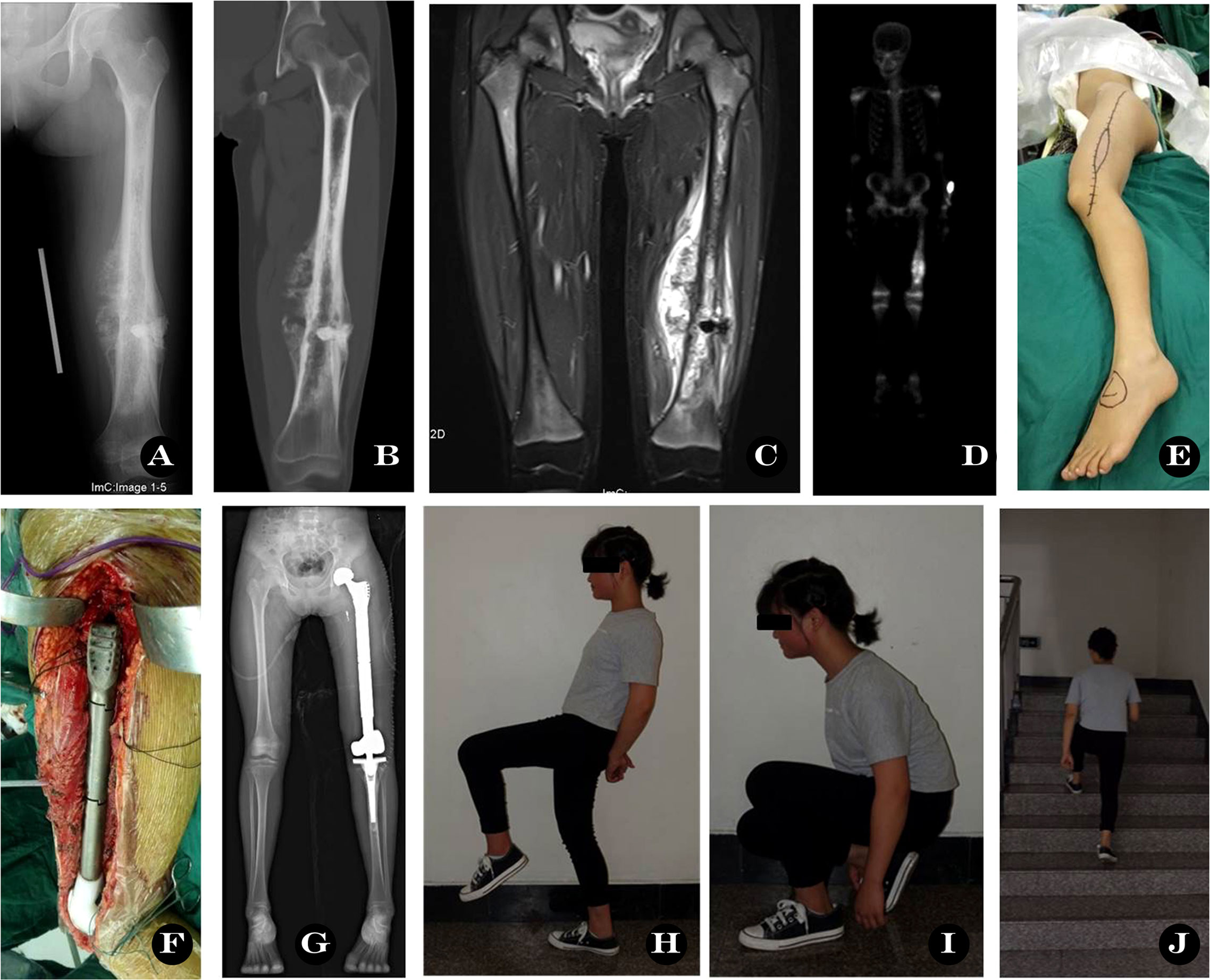 Frontiers Preserving the rectus femoris and improving limb