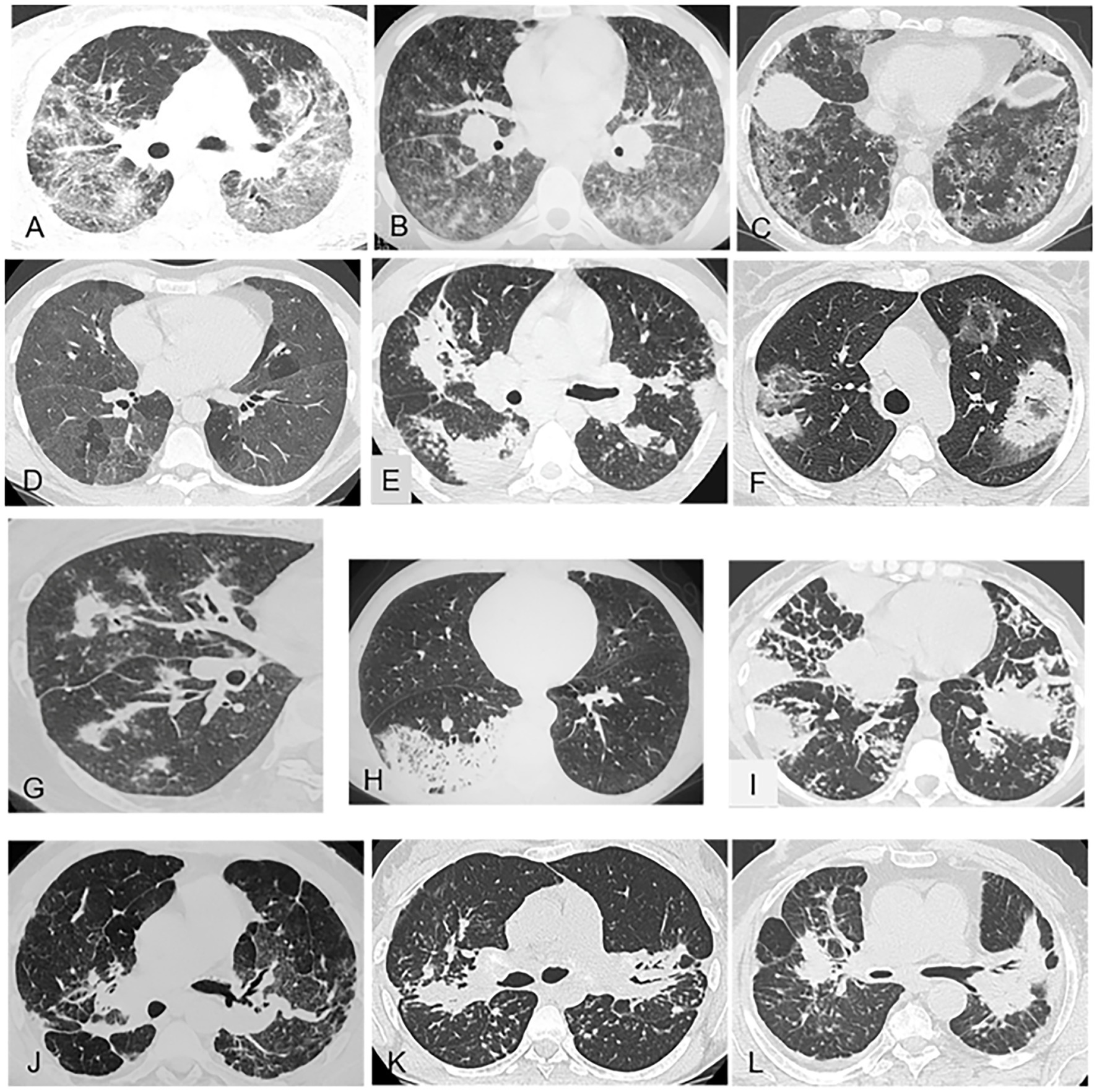 Pulmonary nodules in African migrants caused by chronic