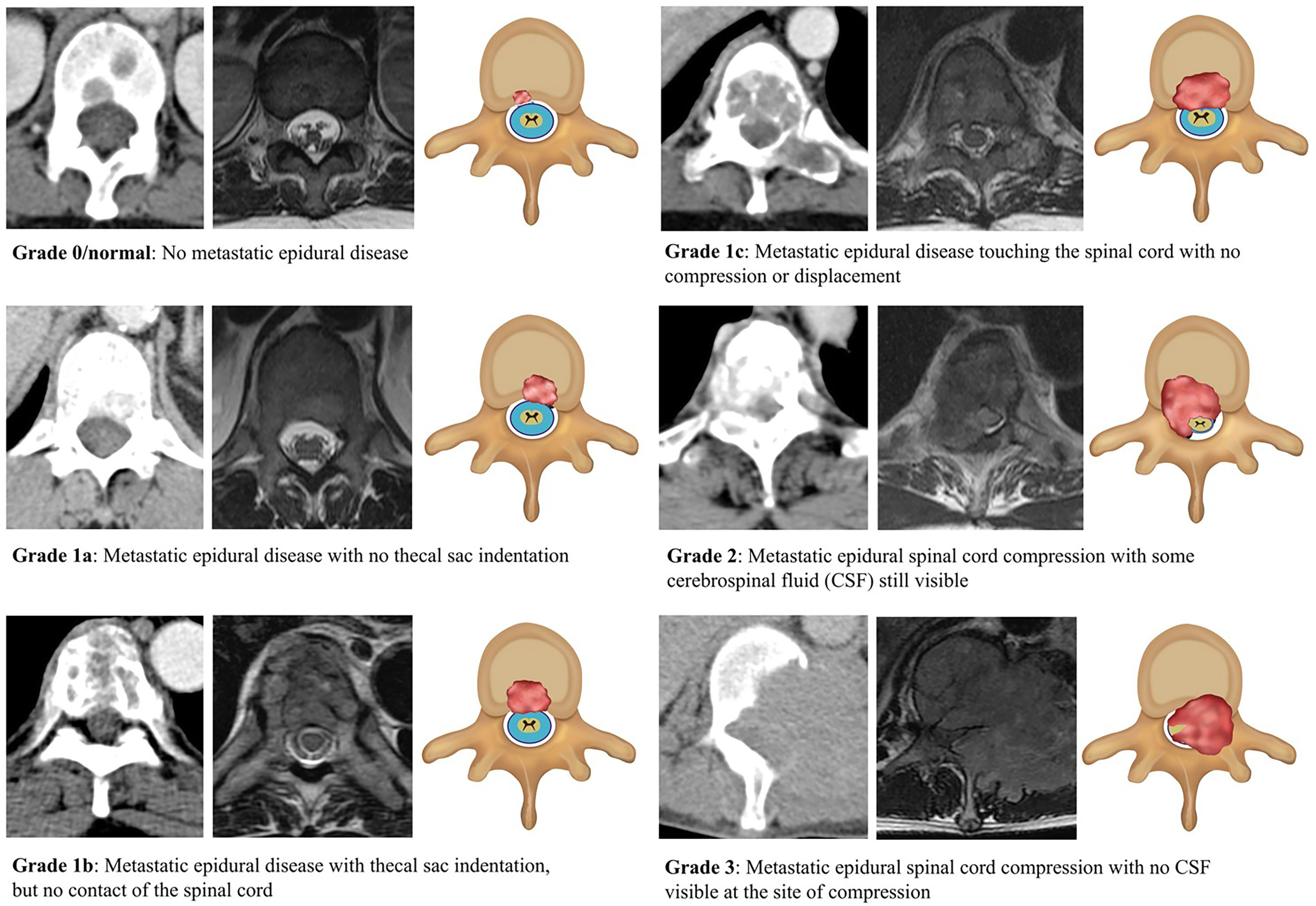 Frontiers  Deep learning assessment compared to radiologist reporting for  metastatic spinal cord compression on CT