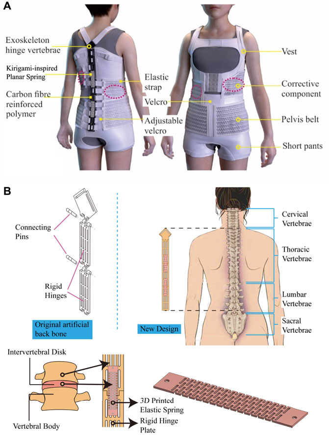 Frontiers  Design and characterize of kirigami-inspired springs and the  application in vertebrae exoskeleton for adolescent idiopathic scoliosis  brace treatment