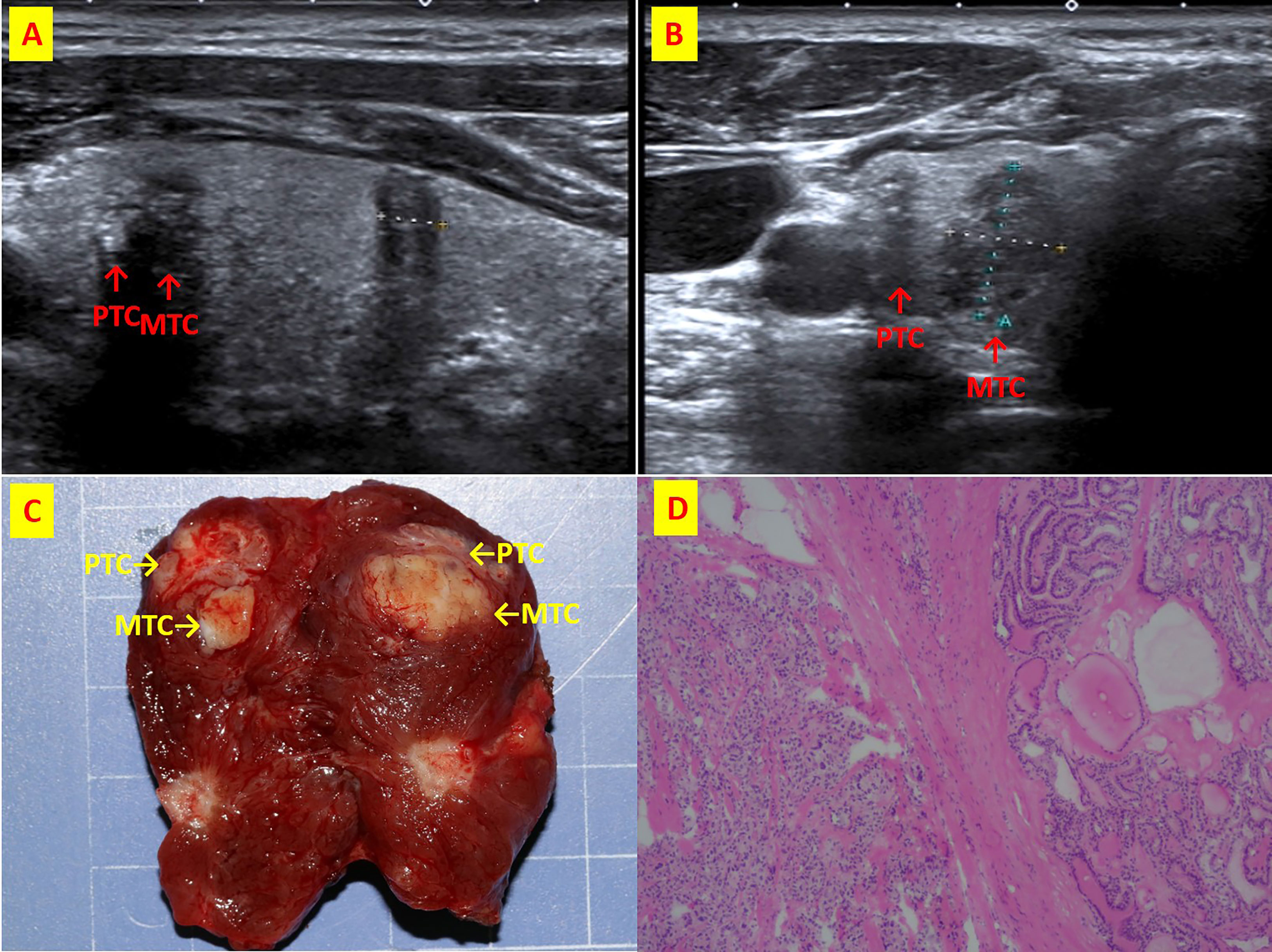 papillary thyroid carcinoma gross