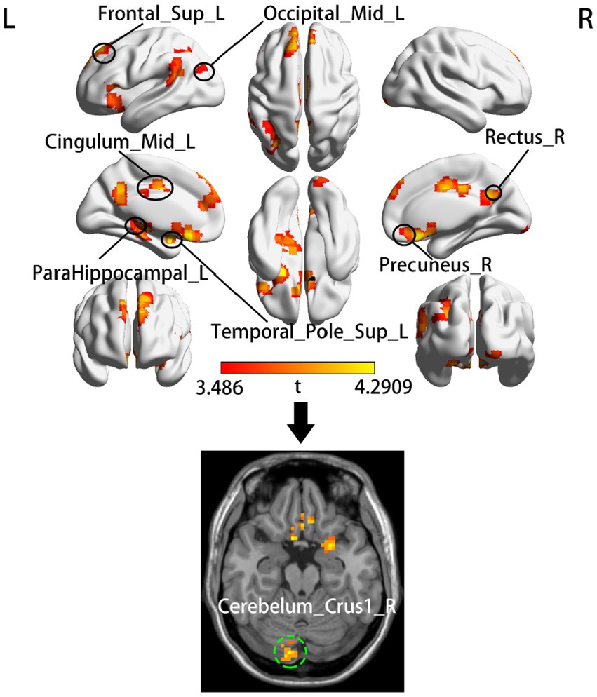 Frontiers  Relationship between temporal dynamics of intrinsic brain  activity and motor function remodeling in patients with acute BGIS
