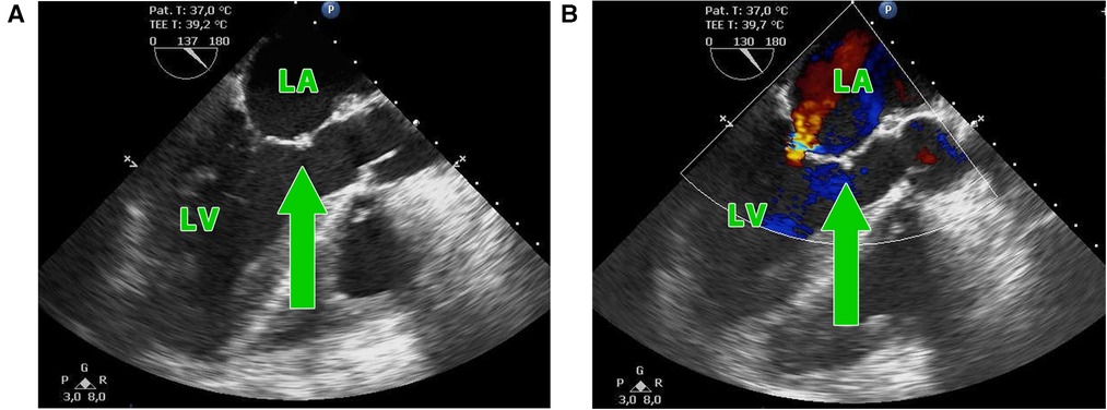 Frontiers | Aorto-mitral curtain reconstruction in invasive double ...