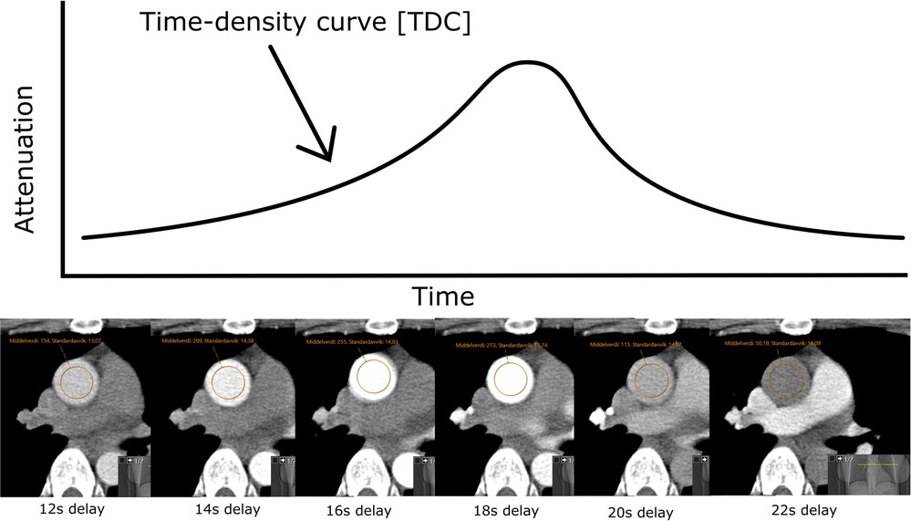 Intravenous Contrast Medium Administration and Scan Timing at CT:  Considerations and Approaches