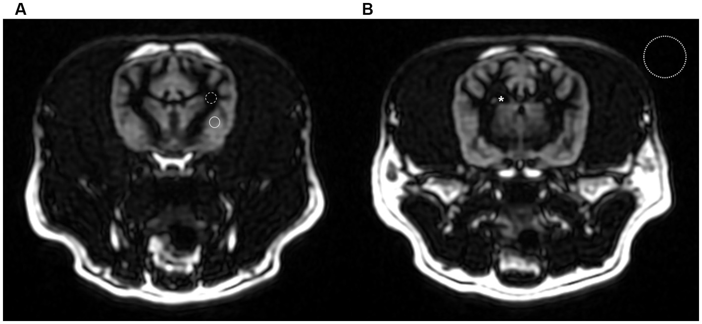 High-resolution 3D T1-weighted turbo fi eld echo imaging of the brain.