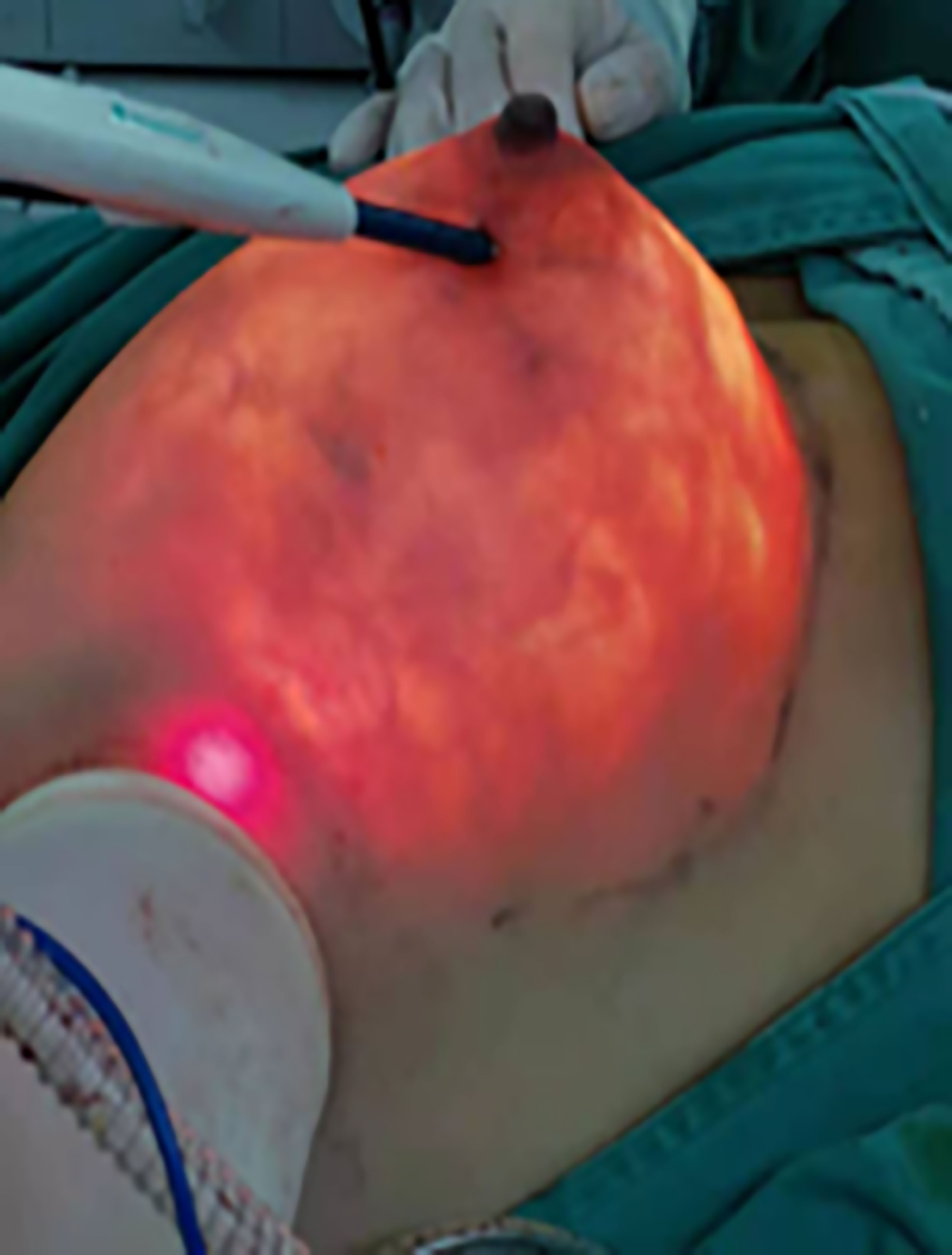 Endoscopic nipple sparing mastectomy with immediate implant-based