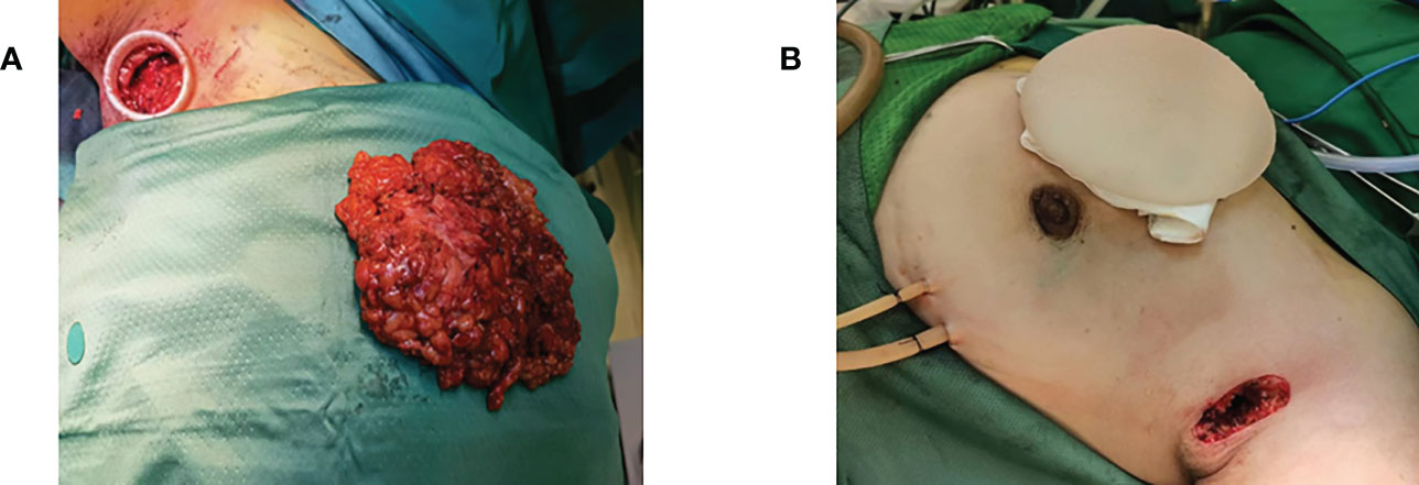 Frontiers  Trans-axillary single port insufflation technique-assisted  endoscopic surgery for breast diseases: Clinic experience, cosmetic outcome  and oncologic result