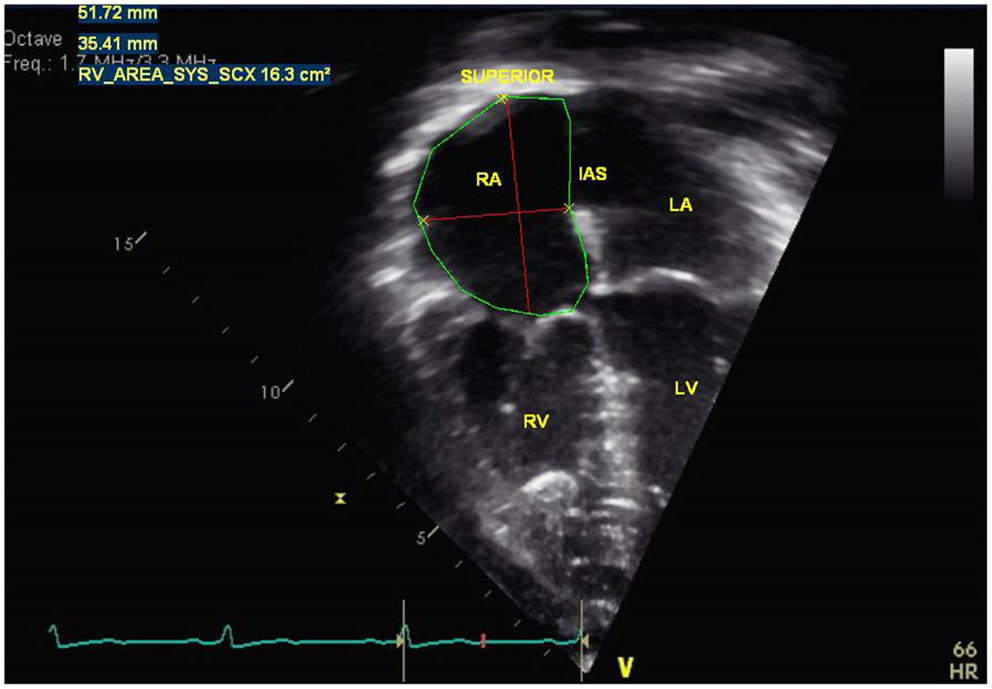Frontiers | Echocardiography in Pediatric Pulmonary Hypertension | Pediatrics