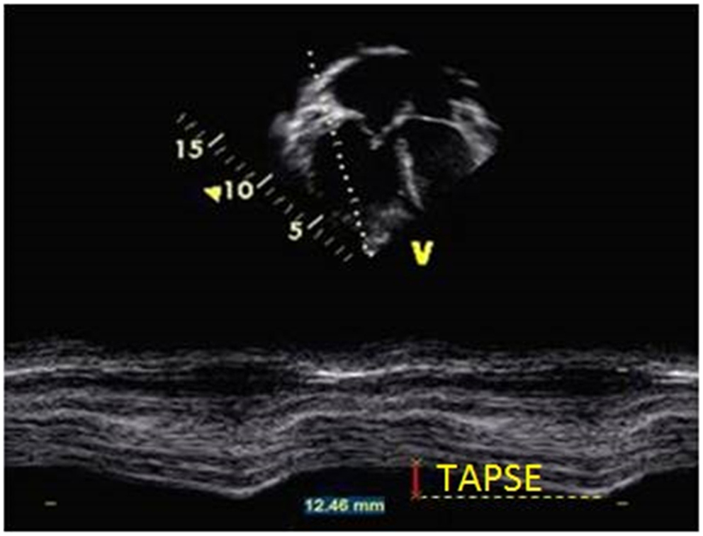Frontiers  Echocardiography in Pediatric Pulmonary 
