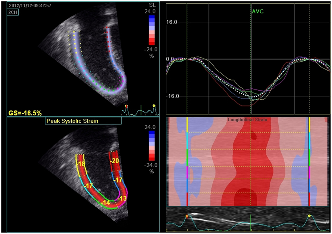 SPECKLE TRACKING RV GLOBAL LONGITUDINAL STRAIN FOR PREDICTION OF PULMONARY  HYPERTENSION - Canadian Journal of Cardiology