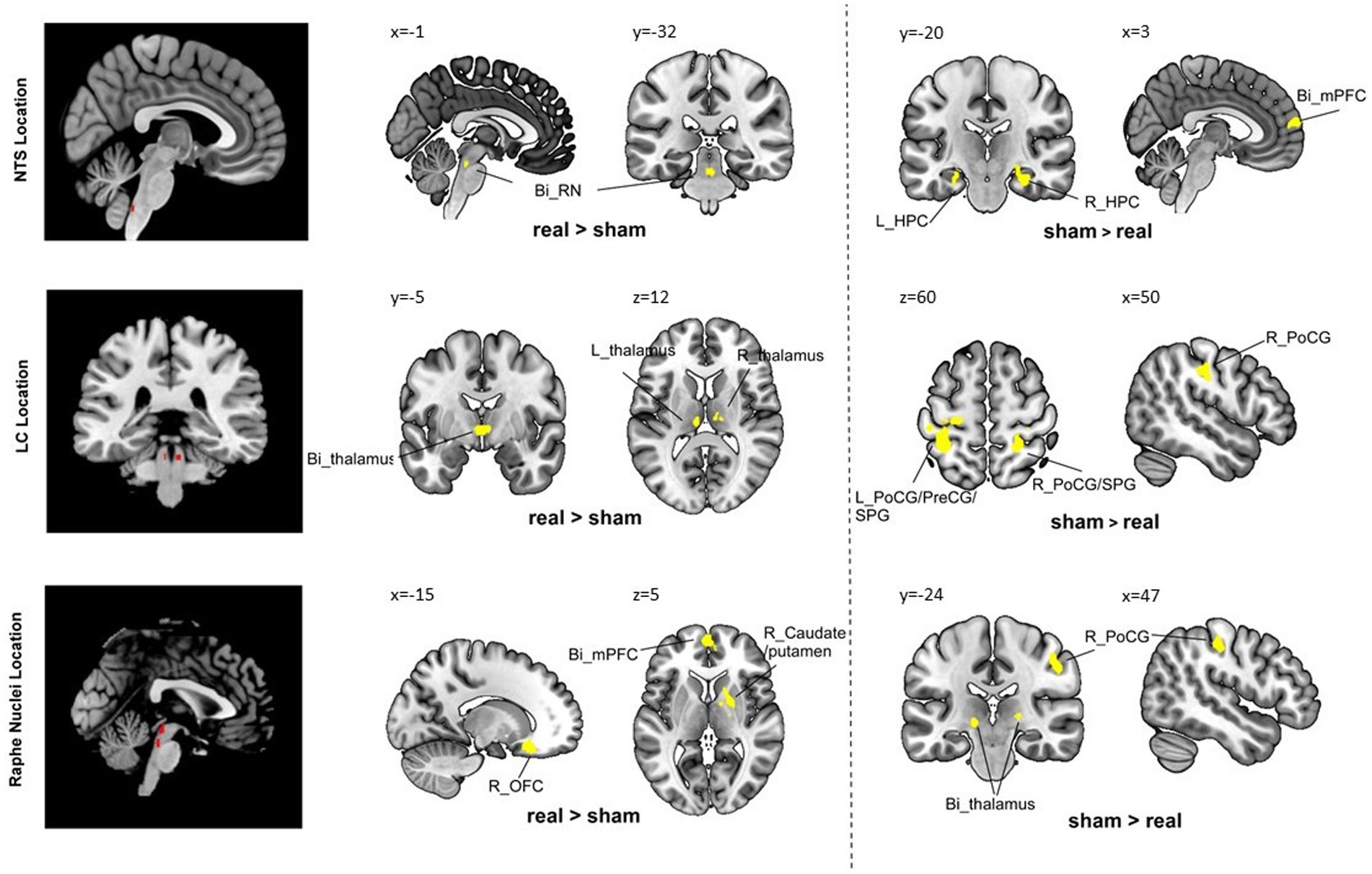 The vagus afferent network: emerging role in translational connectomics in:  Neurosurgical Focus Volume 45 Issue 3 (2018) Journals