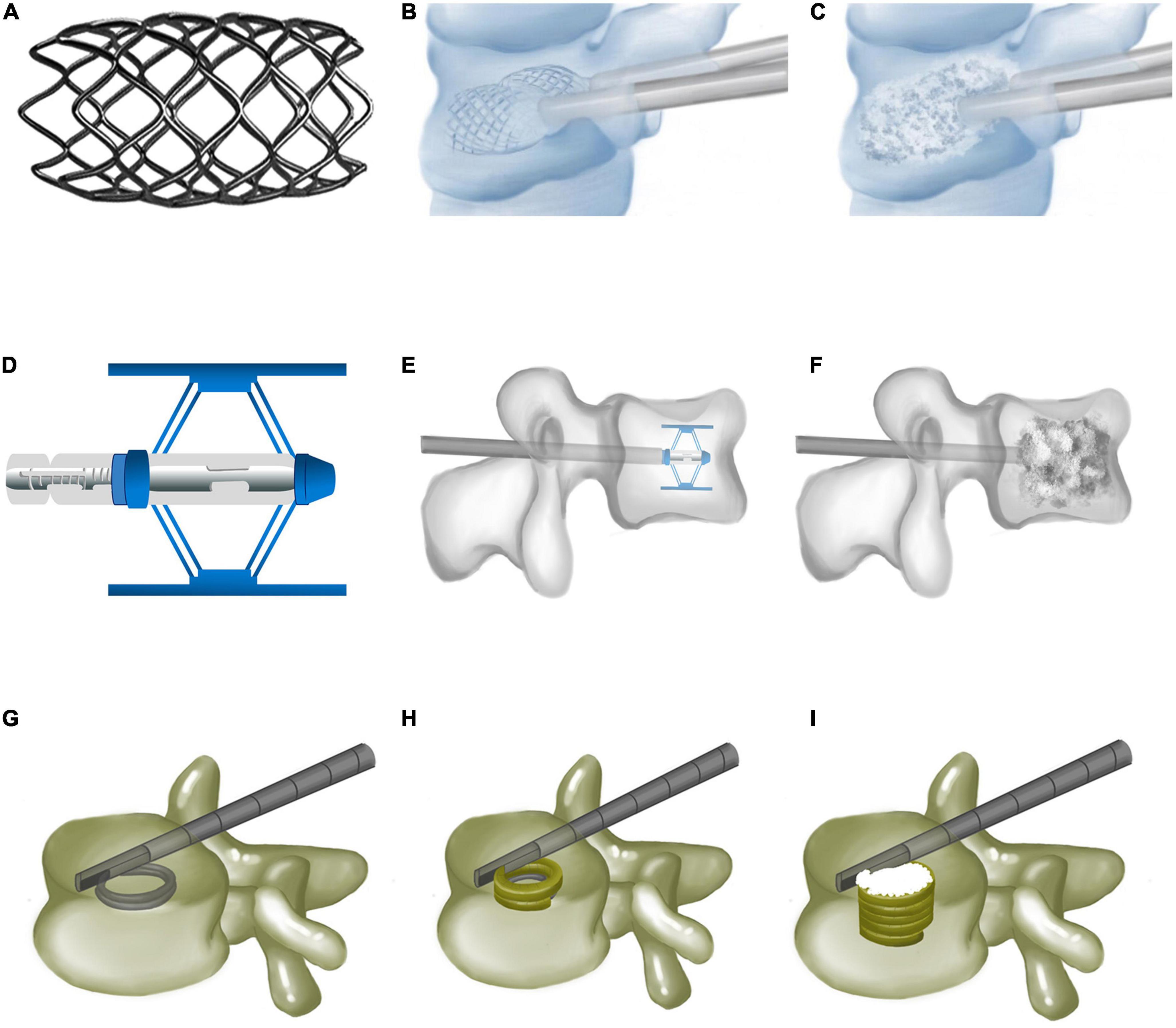 Spinal Compression Fracture Guide