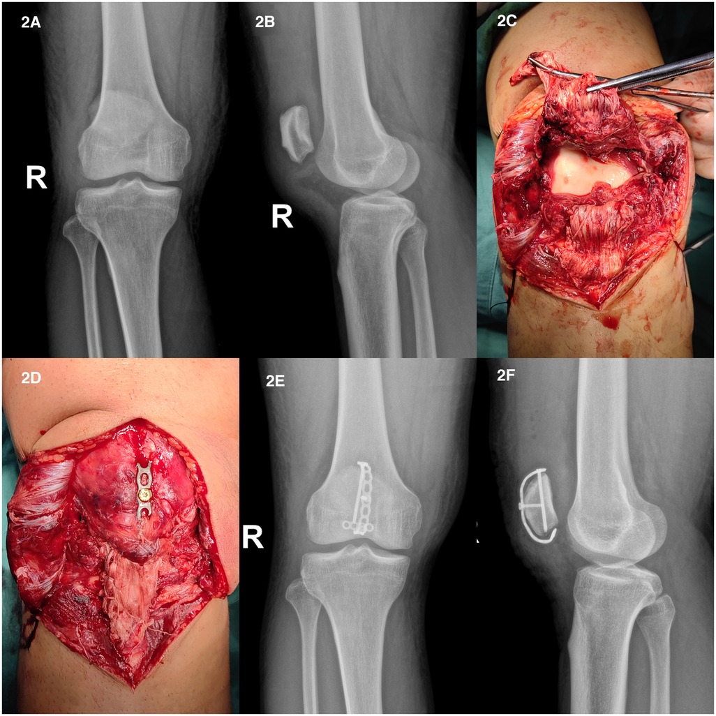 Frontiers Treatment of proximal patellar tendon rupture with