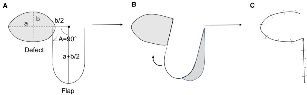 Frontiers Application Of Vertical Transposition Flap In Closure For