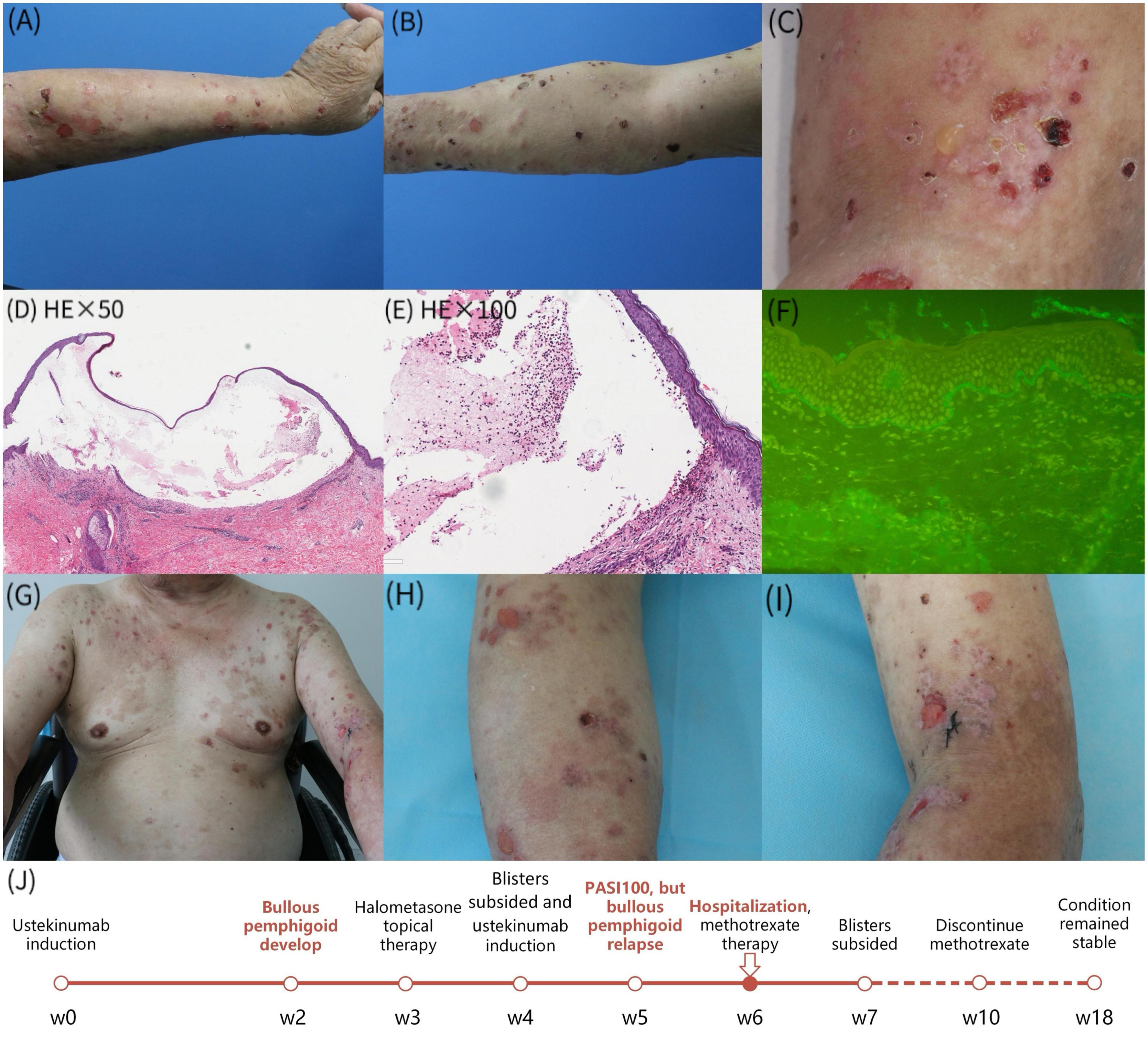 Frontiers Development Of Bullous Pemphigoid During Treatment Of