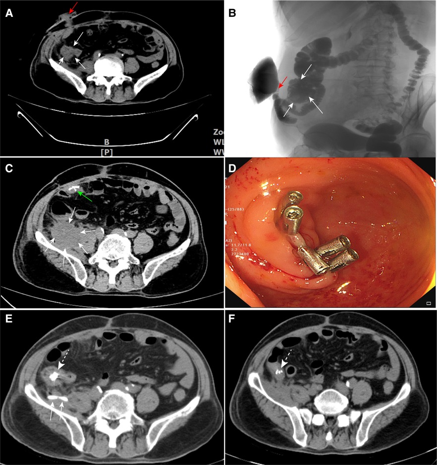 Frontiers Colonoscopic titanium clipping to Maddress appendiceal