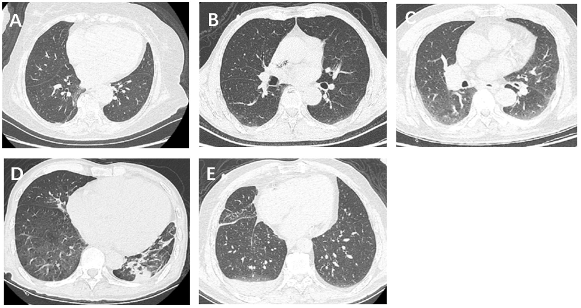 Frontiers Evaluating cardiac function with chest computed tomography in acute ischemic stroke feasibility and correlation with short-term outcome photo