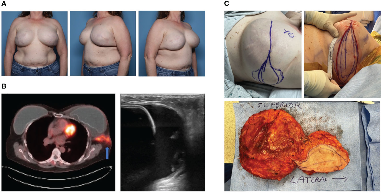 A) Clinical presentation of breast enlargement with periimplant