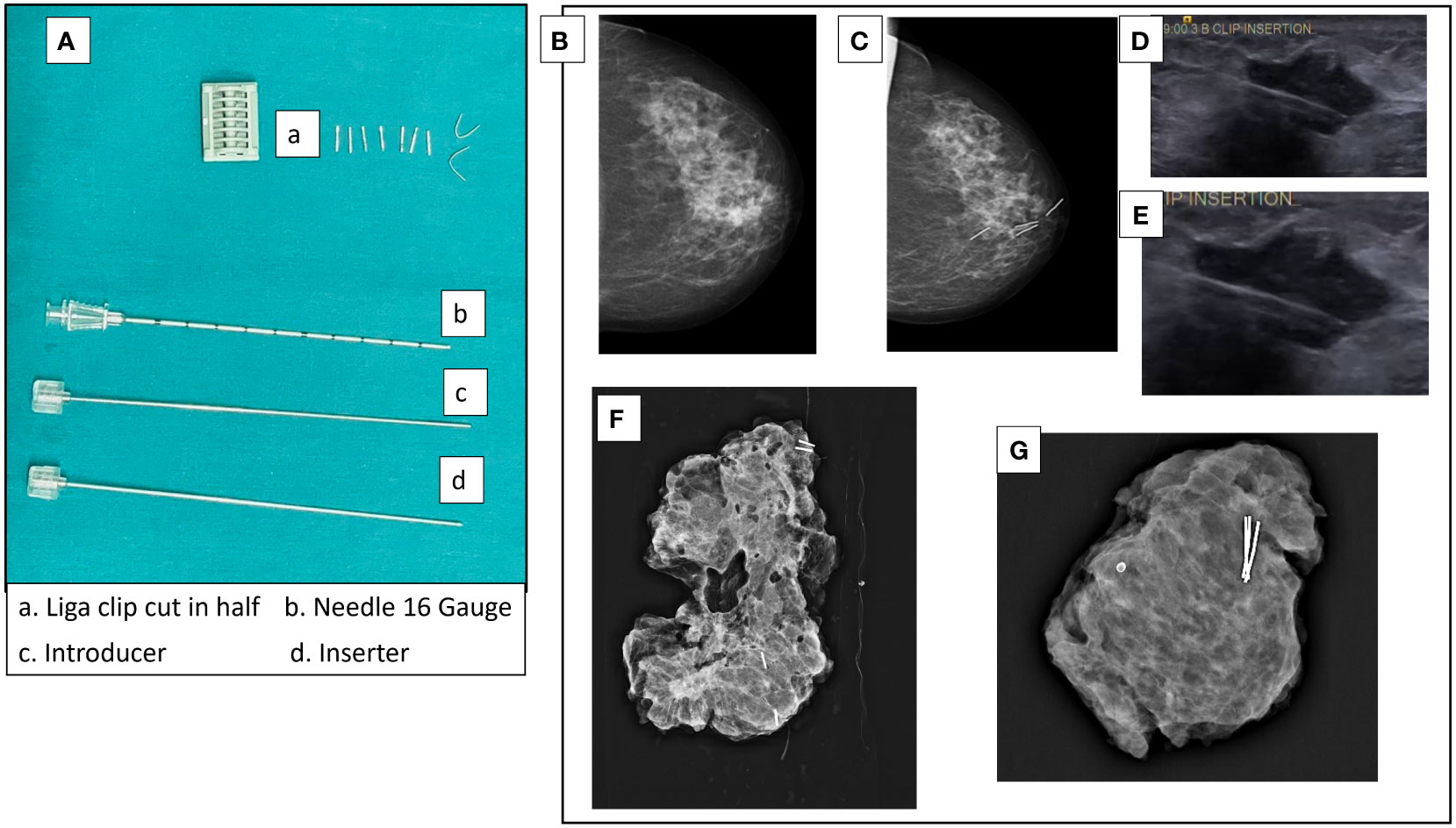 Frontiers | Impact of oncoplasty in increasing breast conservation