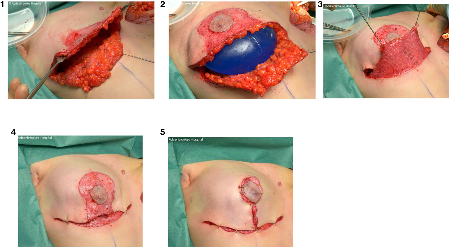 Dressmaking Debacles: Breast Reduction Surgery Pt. 2