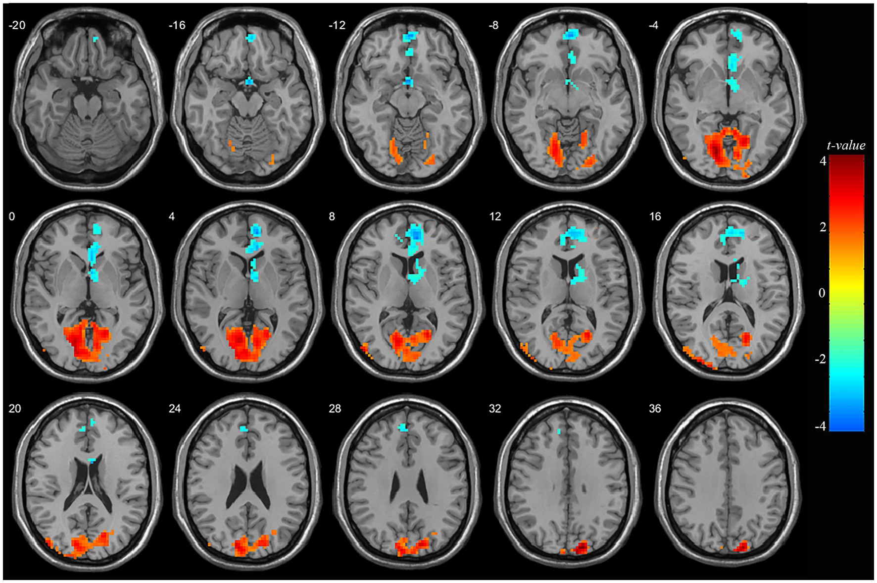 Frontiers  Abnormal brain spontaneous activity in major